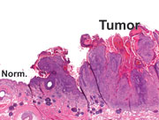 Normal skin (Norm) with adjacent squamous cell carcinoma (Tumor). John T. Seykora, MD, PhD, University of Pennsylvania School of Medicine